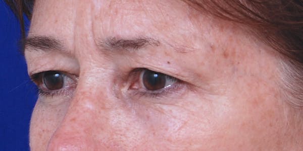 Eyelid Surgery Before & After Gallery - Patient 60806640 - Image 3