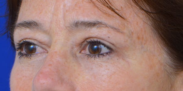 Eyelid Surgery Before & After Gallery - Patient 60806640 - Image 4