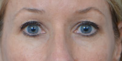 Eyelid Surgery Before & After Gallery - Patient 60806641 - Image 1