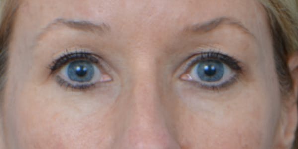 Eyelid Surgery Before & After Gallery - Patient 60806641 - Image 1
