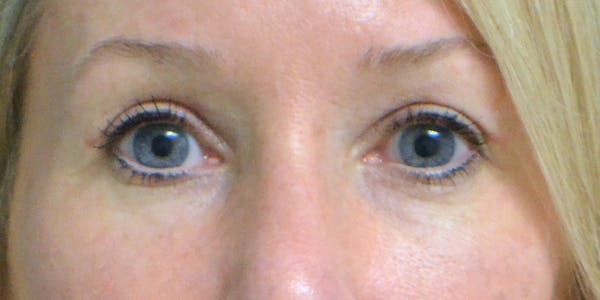 Eyelid Surgery Before & After Gallery - Patient 60806641 - Image 2