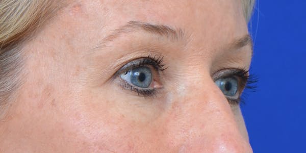 Eyelid Surgery Before & After Gallery - Patient 60806641 - Image 3
