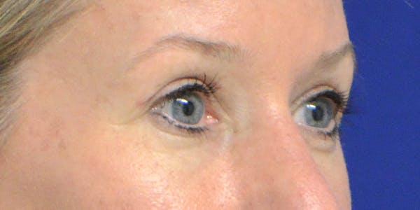 Eyelid Surgery Gallery - Patient 60806641 - Image 4