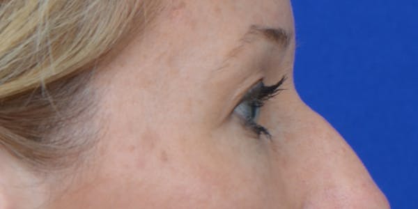 Eyelid Surgery Before & After Gallery - Patient 60806641 - Image 5