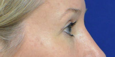 Eyelid Surgery Before & After Gallery - Patient 60806641 - Image 6