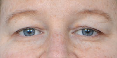 Eyelid Surgery Before & After Gallery - Patient 60806642 - Image 1