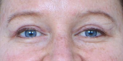 Eyelid Surgery Before & After Gallery - Patient 60806642 - Image 2