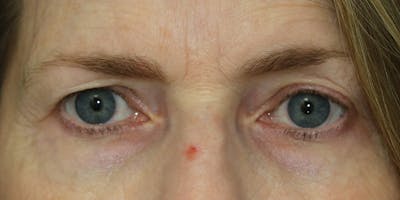 Eyelid Surgery Before & After Gallery - Patient 60806643 - Image 1