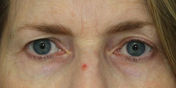Eyelid Surgery Before & After Gallery - Patient 60806643 - Image 1