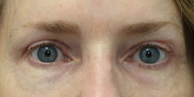Eyelid Surgery Before & After Gallery - Patient 60806643 - Image 2