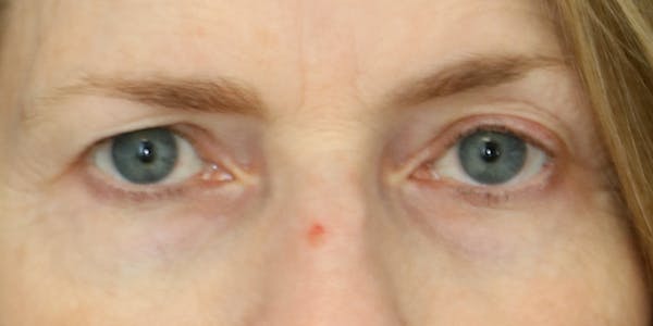 Eyelid Surgery Before & After Gallery - Patient 60806643 - Image 3