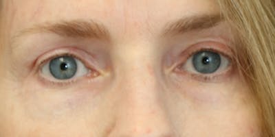 Eyelid Surgery Before & After Gallery - Patient 60806643 - Image 4