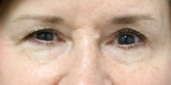 Eyelid Surgery Before & After Gallery - Patient 60806644 - Image 1
