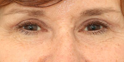 Eyelid Surgery Before & After Gallery - Patient 60806644 - Image 2