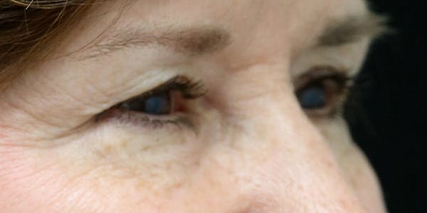 Eyelid Surgery Before & After Gallery - Patient 60806644 - Image 3