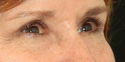 Eyelid Surgery Before & After Gallery - Patient 60806644 - Image 4