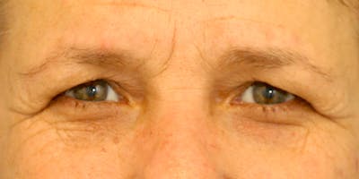 Eyelid Surgery Before & After Gallery - Patient 60806645 - Image 1