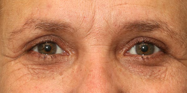 Eyelid Surgery Before & After Gallery - Patient 60806645 - Image 2