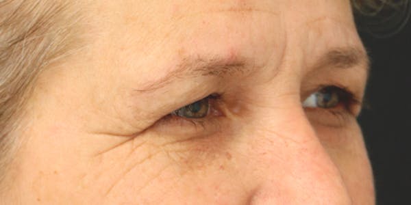 Eyelid Surgery Before & After Gallery - Patient 60806645 - Image 3