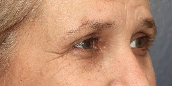 Eyelid Surgery Before & After Gallery - Patient 60806645 - Image 4