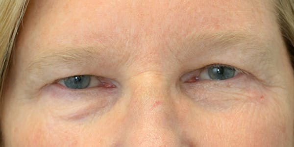 Eyelid Surgery Gallery - Patient 60806646 - Image 1