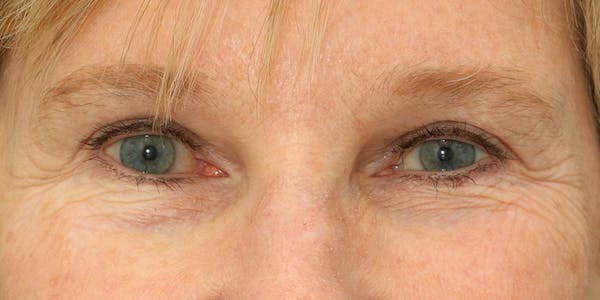 Eyelid Surgery Before & After Gallery - Patient 60806646 - Image 2
