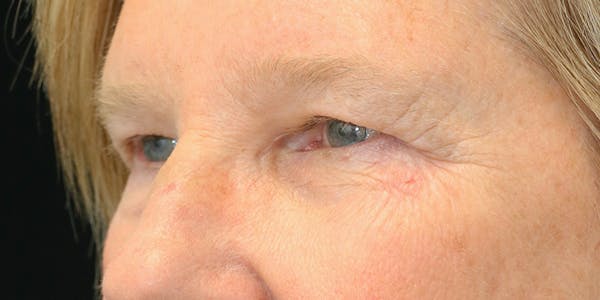 Eyelid Surgery Before & After Gallery - Patient 60806646 - Image 3