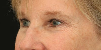 Eyelid Surgery Before & After Gallery - Patient 60806646 - Image 4