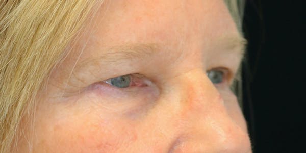 Eyelid Surgery Before & After Gallery - Patient 60806646 - Image 5