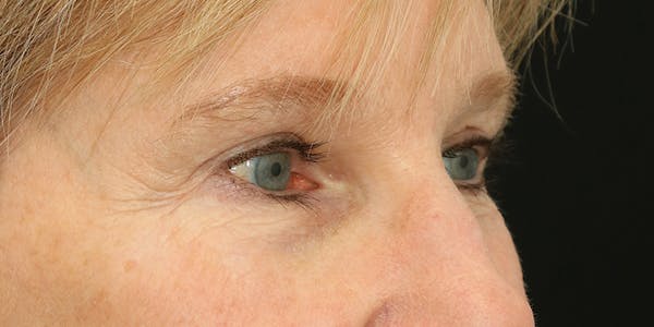 Eyelid Surgery Gallery - Patient 60806646 - Image 6