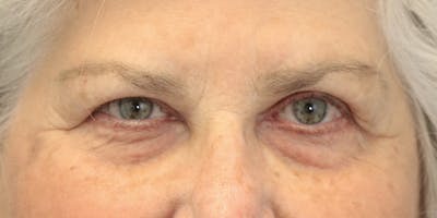 Eyelid Surgery Before & After Gallery - Patient 60806647 - Image 1