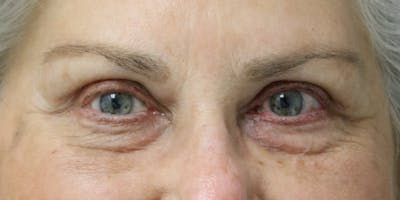 Eyelid Surgery Before & After Gallery - Patient 60806647 - Image 2