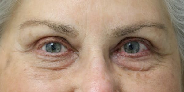 Eyelid Surgery Before & After Gallery - Patient 60806647 - Image 2