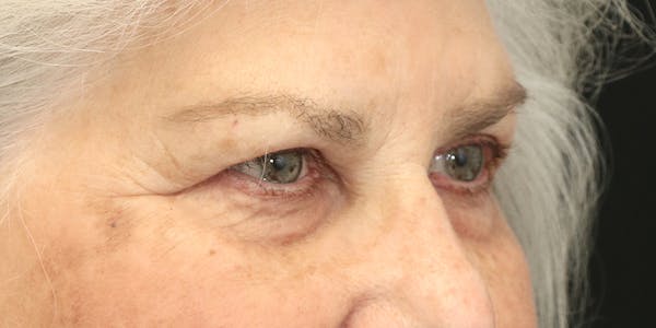 Eyelid Surgery Before & After Gallery - Patient 60806647 - Image 3