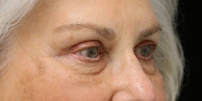 Eyelid Surgery Before & After Gallery - Patient 60806647 - Image 4