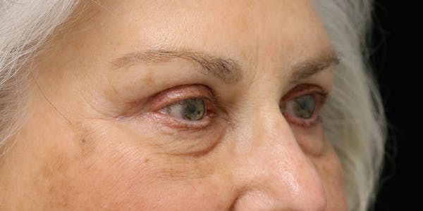Eyelid Surgery Before & After Gallery - Patient 60806647 - Image 4