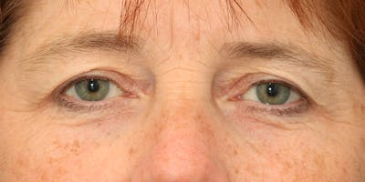 Eyelid Surgery Before & After Gallery - Patient 60806648 - Image 1
