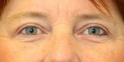 Eyelid Surgery Before & After Gallery - Patient 60806648 - Image 2