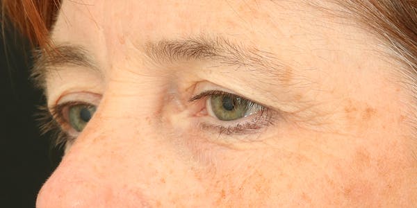 Eyelid Surgery Before & After Gallery - Patient 60806648 - Image 3