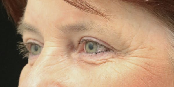 Eyelid Surgery Before & After Gallery - Patient 60806648 - Image 4