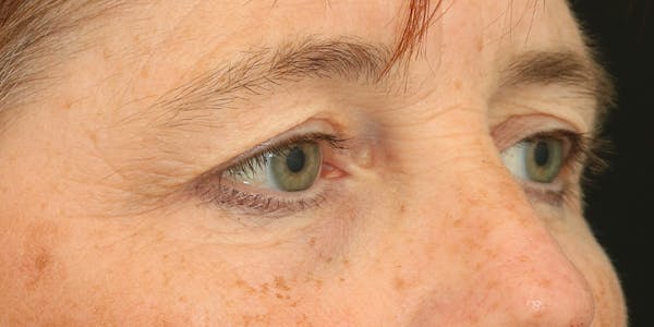 Eyelid Surgery Before & After Gallery - Patient 60806648 - Image 5