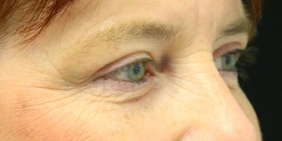 Eyelid Surgery Before & After Gallery - Patient 60806648 - Image 6