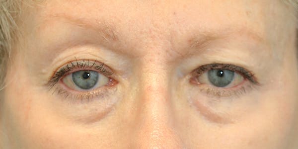 Eyelid Surgery Before & After Gallery - Patient 60806649 - Image 1