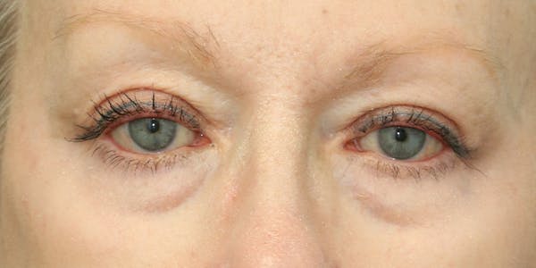 Eyelid Surgery Before & After Gallery - Patient 60806649 - Image 2