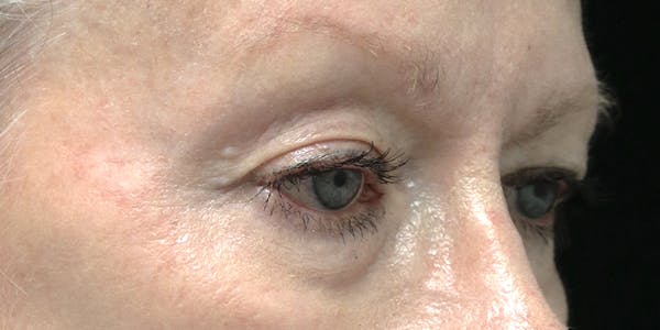 Brow Lift Before & After Gallery - Patient 60806839 - Image 3