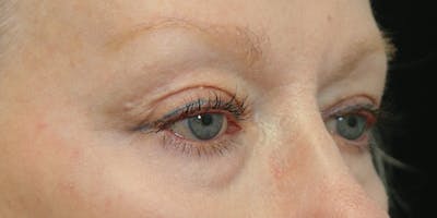 Eyelid Surgery Before & After Gallery - Patient 60806649 - Image 4