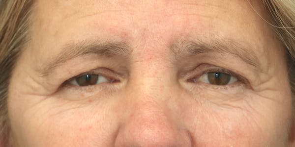 Brow Lift Before & After Gallery - Patient 60806840 - Image 1