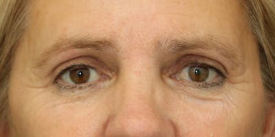 Eyelid Surgery Before & After Gallery - Patient 60806650 - Image 2