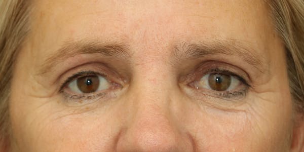 Eyelid Surgery Before & After Gallery - Patient 60806650 - Image 2