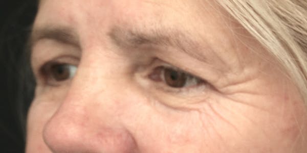 Brow Lift Before & After Gallery - Patient 60806840 - Image 3